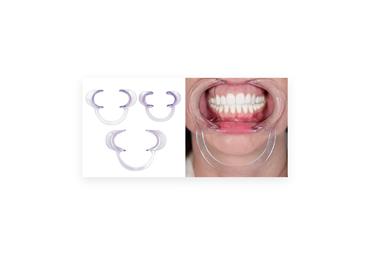 Extraoral Cheek Retractors