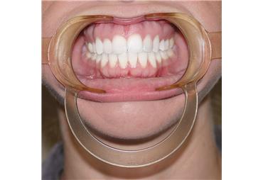 Extraoral Cheek Retractors Heat Sterilizable